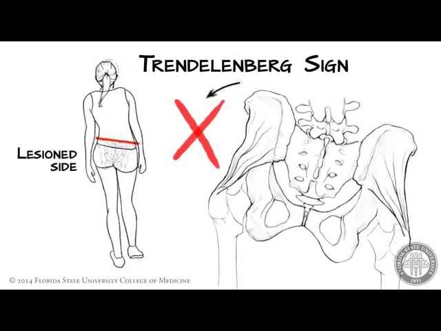 The Trendelenberg Sign [HD]