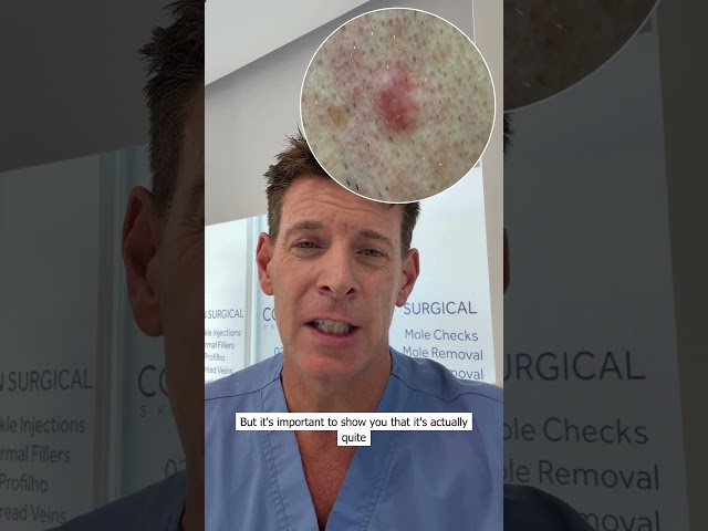 Basal Cell Carcinoma (BCC) - How to Spot the Subtle Signs