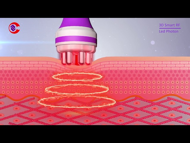 How Does RF Radio Frequency Facial Skin Tightening Work?