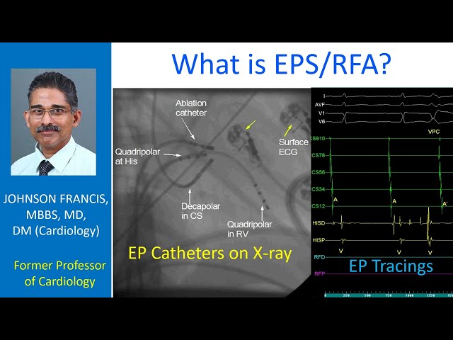 What is EPS/RFA?