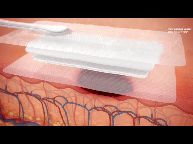 PICO Mechanism of Action - Open Wounds