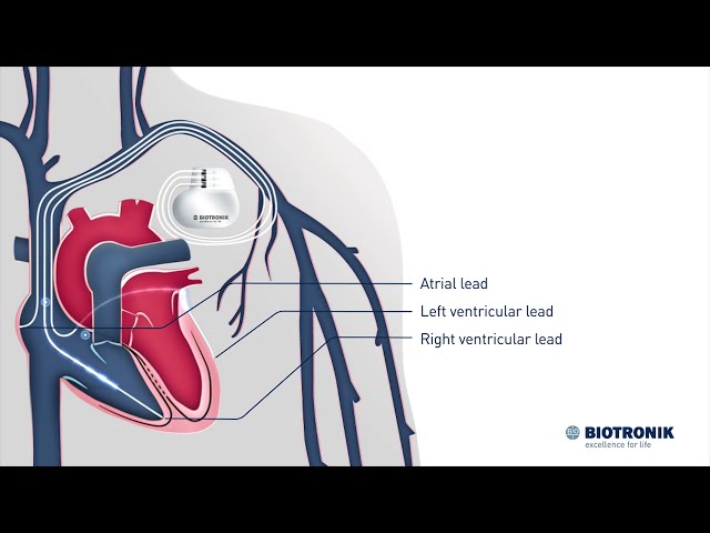 Cardiac Resynchronization Therapy – How it works