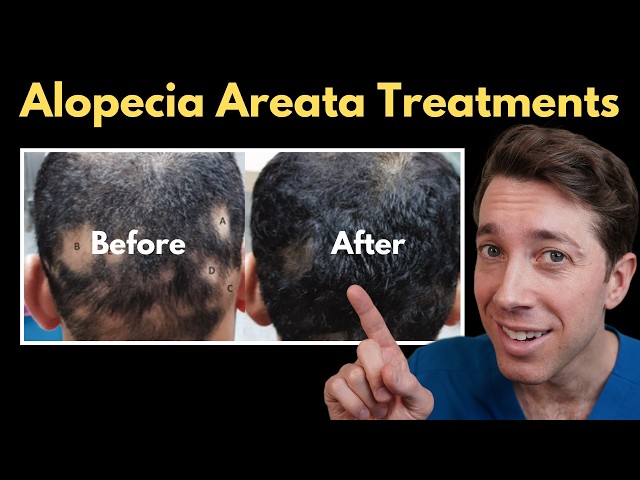 Most Effective Alopecia Areata Treatments