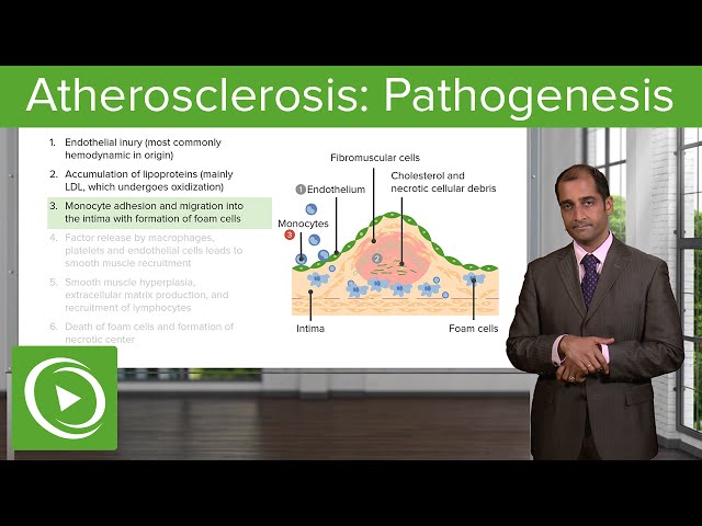 Atherosclerosis: Pathogenesis & Supply/Demand Mismatch – Cardiovascular Pathology | Lecturio