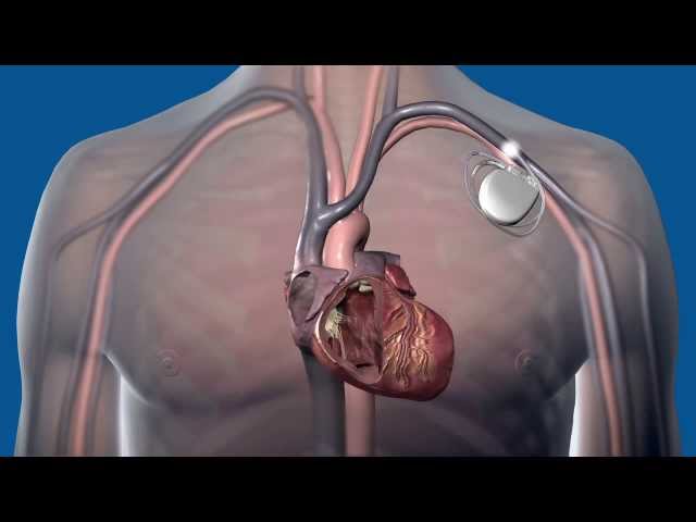 What is a defibrillator, and how does it work?