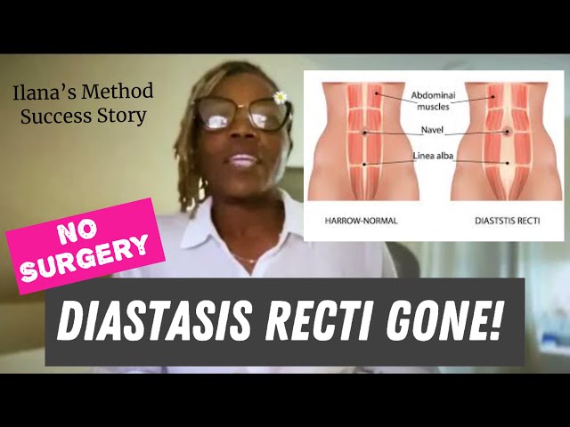 Diastasis Recti / Incontinence Gone! Sexual Vitality Restored