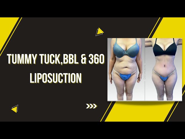 Tummy Tuck,BBL & 360 Liposuction By Dr. Babak Moein