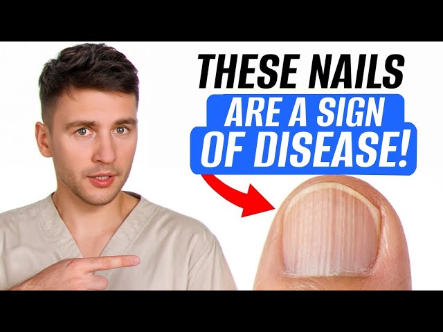 99% of people DON’T use natural indicator of disease 😱 What are your nails trying to tell you?