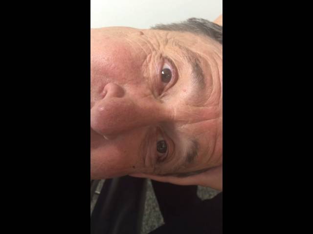 Horizontal Canal BPPV - Watch the Eyes Go Wild!