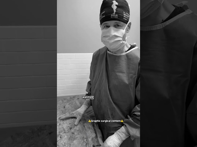 Guess how much weight was removed from this panniculectomy (full surgical video posted)