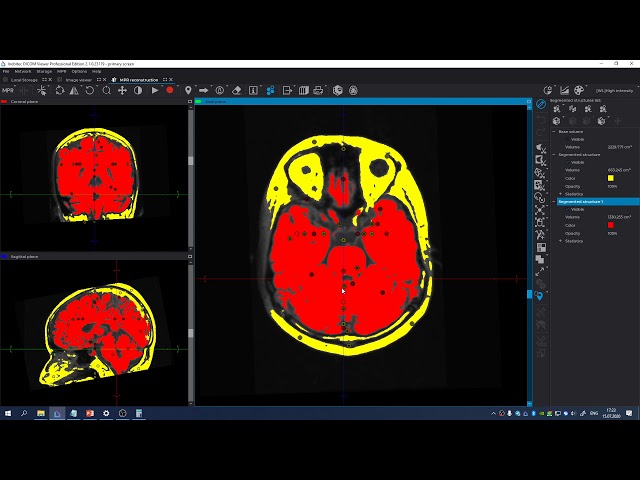 Brain extraction