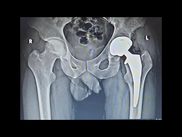 DAA hip replacement- Live Q&A with Dr Pankaj Walecha 09.11.2025