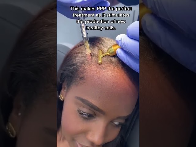 PRP Hair therapy for hair loss | Dr. Medispa