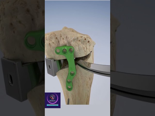 Osteotomy for Osteoarthritis #shorts