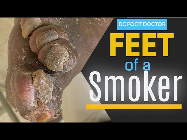 Feet of a Smoker: Severe Effects of Smoking on the Feet, Fungal Toenails and Poor Circulation