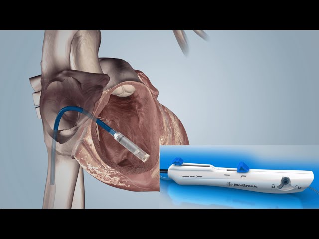 Leadless Pacemaker (PPM) Implantation