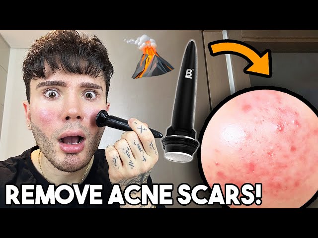 HOW TO GET RID OF ACNE SCARS AND DARK SPOTS || (MICRONEEDLING TUTORIAL WITH BANISH)