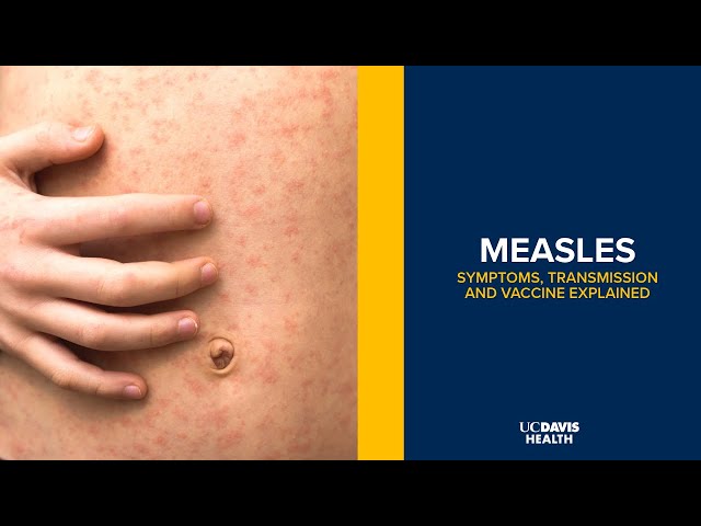 Measles Symptoms, Transmission and Vaccine Explained By a Doctor | UC Davis Health