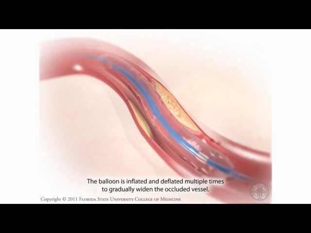 Percutaneous Coronary Intervention- Coronary Angioplasty
