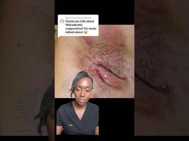 Painful Boils Under Armpits!...Could it be Hidradenitis Suppurativa?