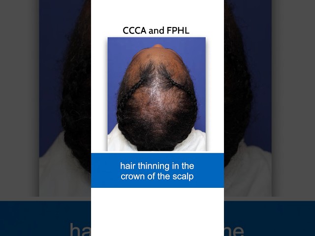 CCCA: Rare Hair Loss in African Women #alopecia