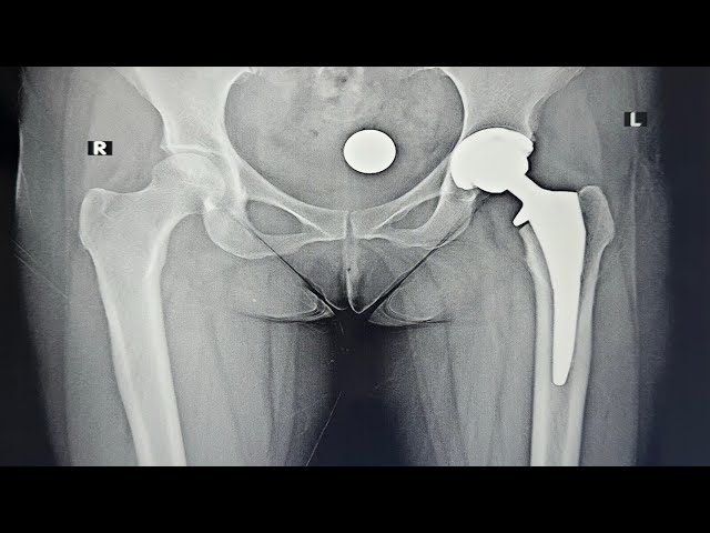 Bikini DAA hip replacement Part 1-Direct Anterior Hip Replacement for THR- LIVE show 05.07.2025