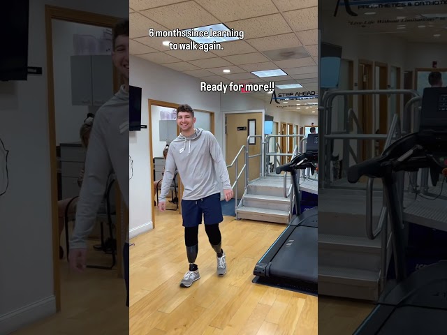 Peyton's Bilateral  Below-Knee Prosthetic Progress