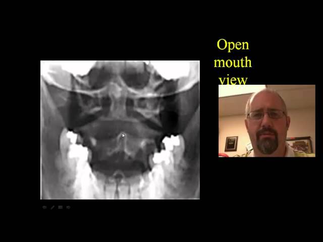 Cervical Spine X-rays