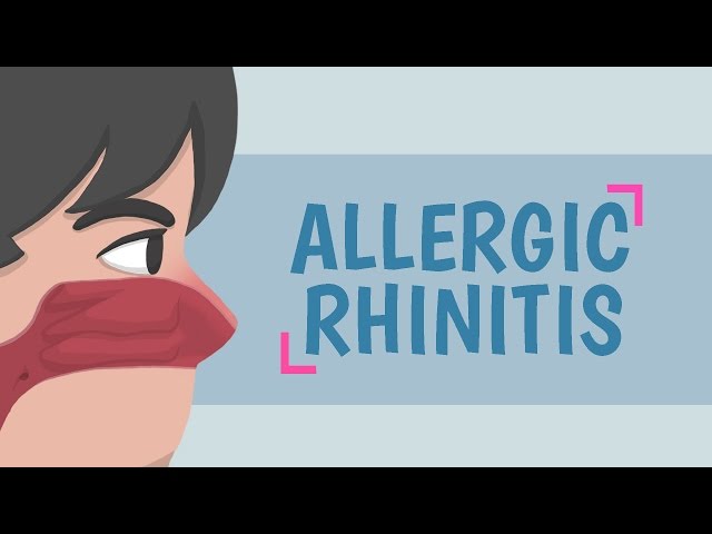 What is Allergic Rhinitis?