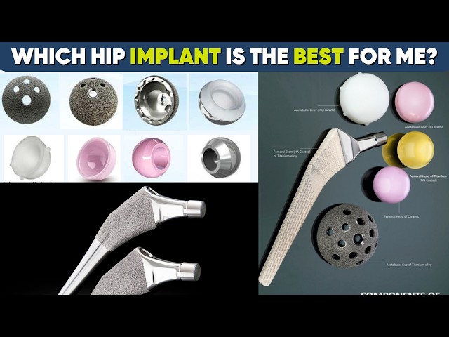 Hip Replacement-Right Implant for You !! || Ceramic vs Metal, cemented vs Uncemented 