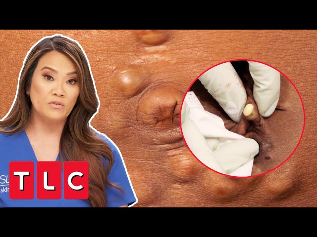 Woman Has Over 500 “PEBBLE” Bumps All Over Her Body | Dr Pimple Popper: This Is Zit