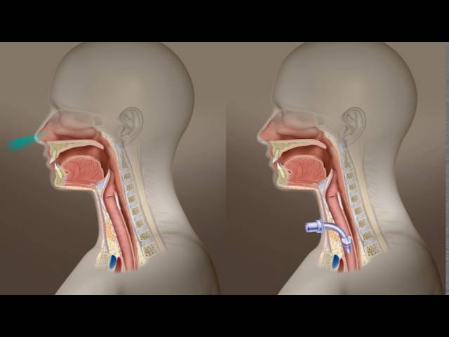Tracheotomy Care: What Is A Tracheotomy