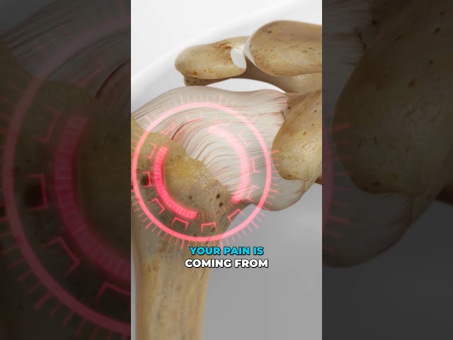 Shoulder Joint Injection Explained in 60 Seconds