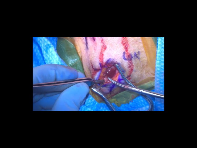 Lesser Occipital Neurectomy