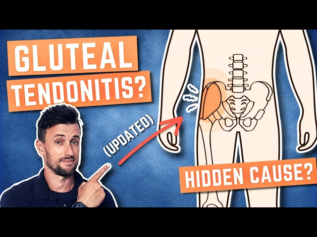 The HIDDEN CAUSE of Gluteal Tendonitis (& How to Self-Treat)