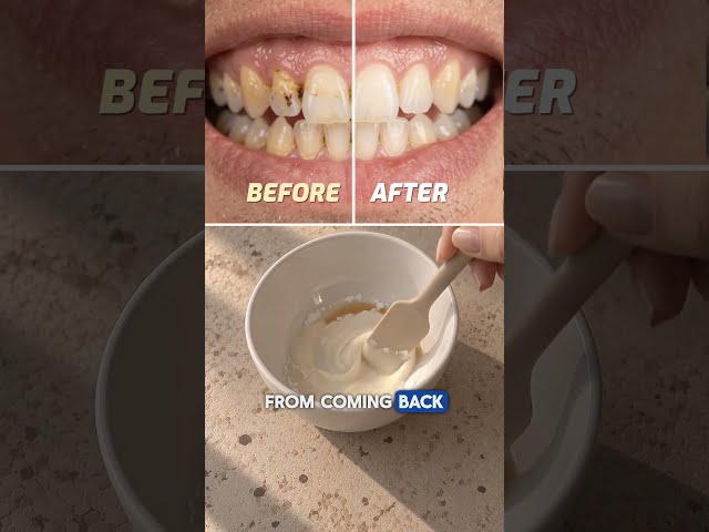 The #1 Best Remedy to Get Rid of Tartar (Natural Toothpaste Recipe)