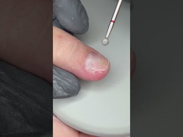 Onycholysis Treatment ASMR💦