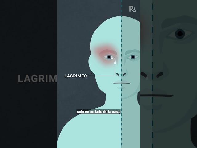¿Qué es una cefalea en racimos?