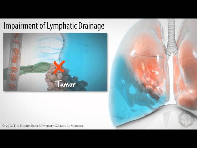 Pleural Space: Part 3 of 3- Pleural Effusions [HD]