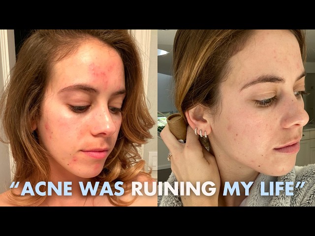 The Acne Episode (so many things I didn’t know about breakouts)