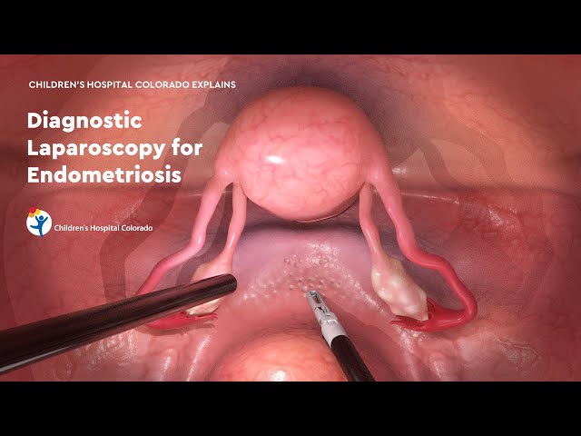 Diagnostic Laparoscopy for Endometriosis