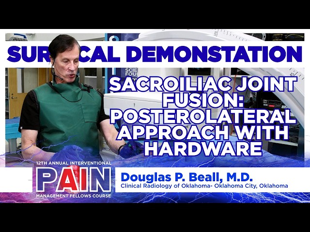 Sacroiliac Joint Fusion: Posterolateral Approach with Hardware - Douglas P Beall, M.D.