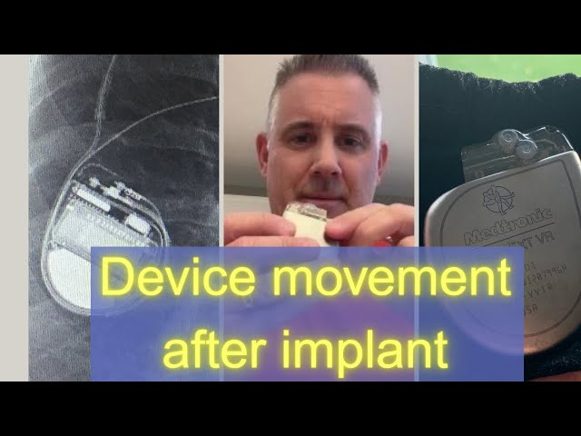 Pacemaker/Defibrillator movement after implant.
