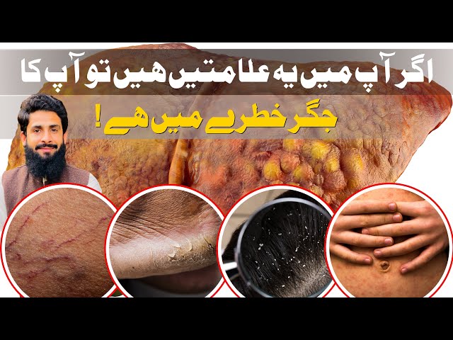 Most Important Signs of Liver Damage | Dr Abubakar Bhutta