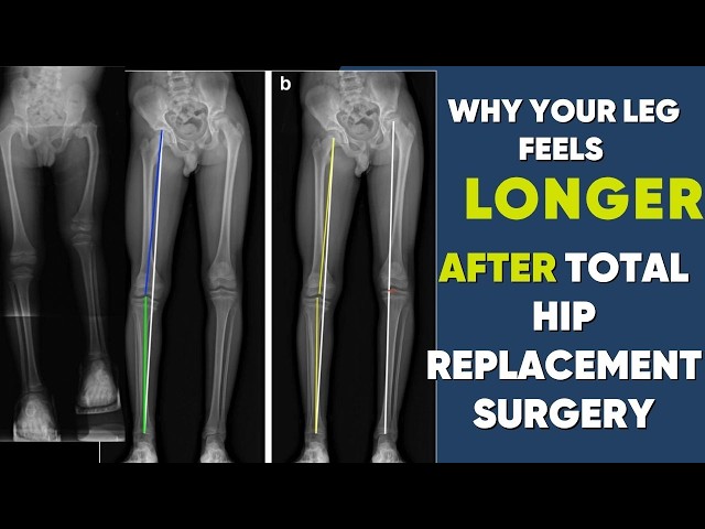 Why Your Leg Feels Longer After Hip Replacement