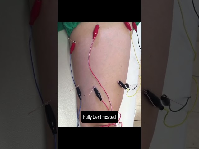 Learn electro Acupuncture Online #manualtherapy ￼