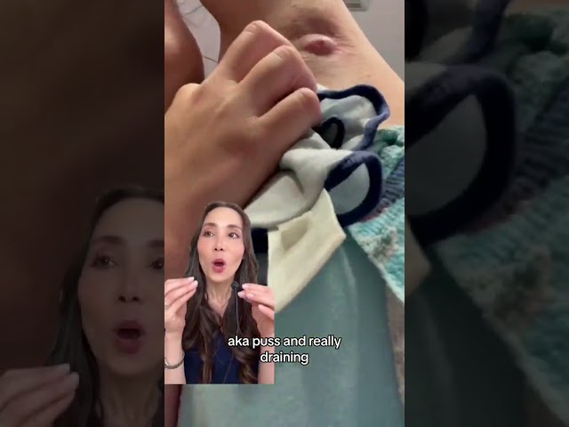 Armpit Cyst