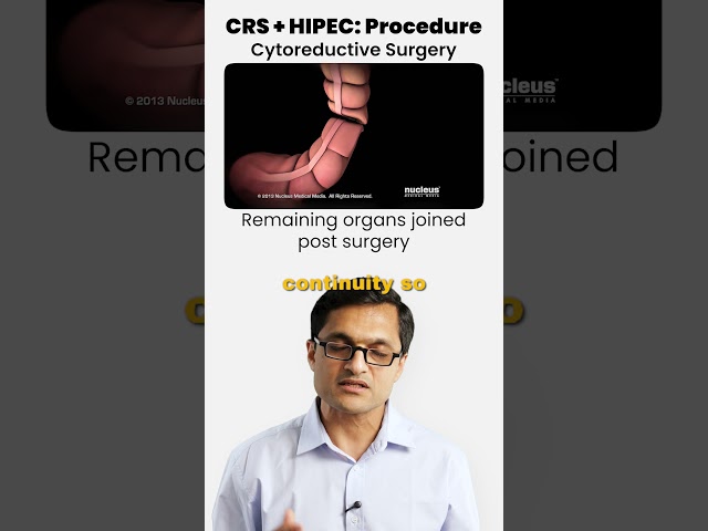 CRS + HIPEC: The procedure explained #crs #cytoreductivesurgery #hipec #cancer #cancertreatment