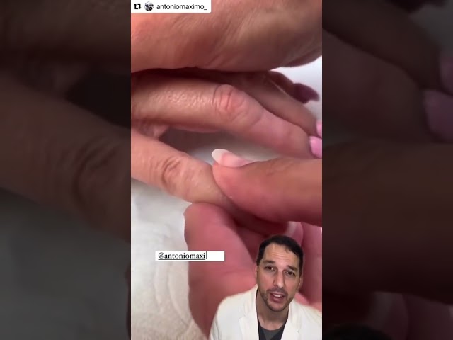 Amazing prosthetic work!#Prosthetic #Finger #Nurse #Dr #Amputation #Artist #Art #Education #Medical