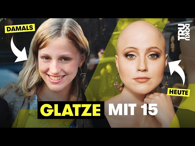 Wenn dir alle Haare ausfallen – Julies Leben mit Alopecia I TRU DOKU
